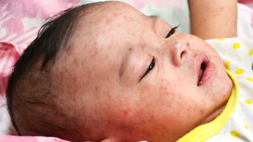 Rawalpindi reports surge in measles cases in early 2026